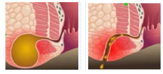肛瘘3.png
