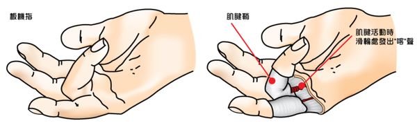 手指疼痛难以伸直？快来看看是不是得了腱鞘炎！