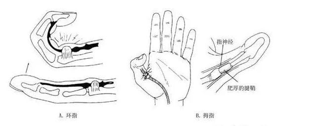 孩子手指伸不直，关节还会发出"噼啪"的响声，要引发重视