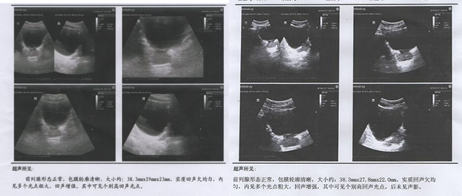 眼科ab超单怎么看一分钟教你轻松看懂前列腺B超单！_https://www.jmylbn.com_新闻资讯_第2张