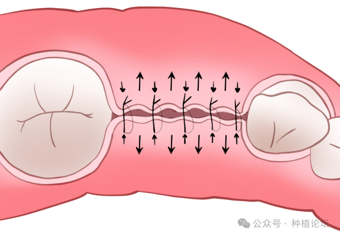 骨增量术后感染的处理及预防