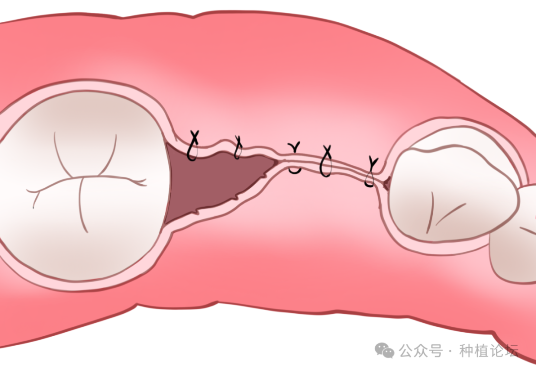 骨增量术后感染的处理及预防