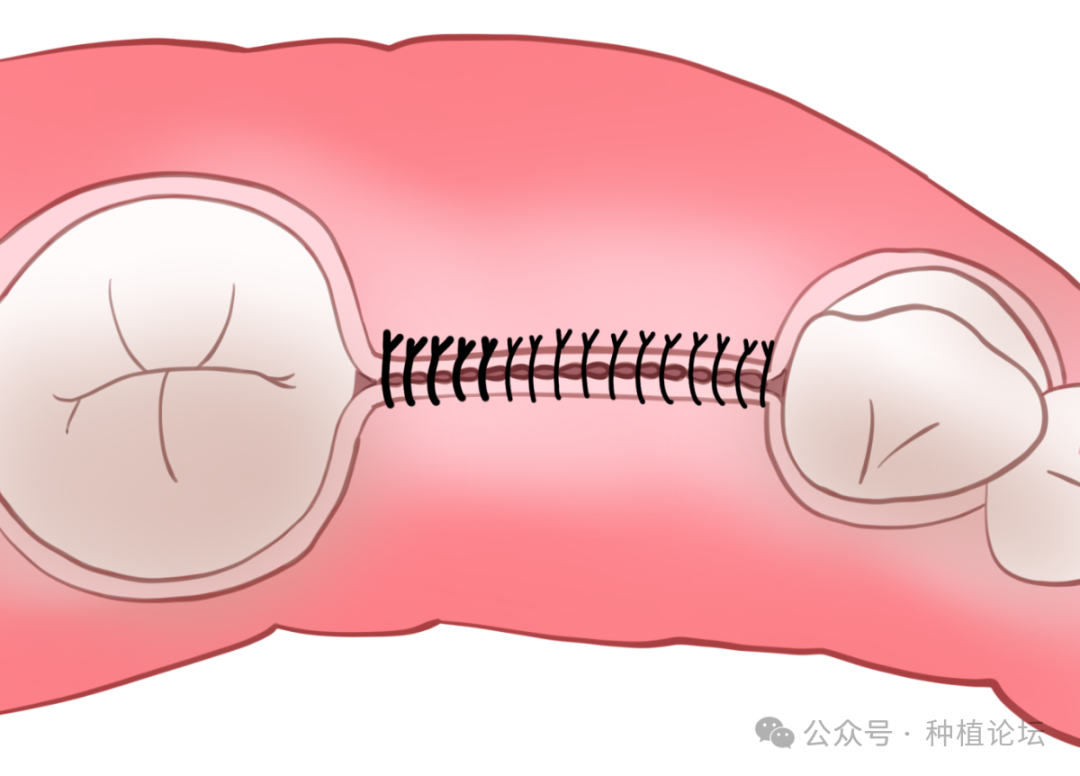骨增量术后感染的处理及预防