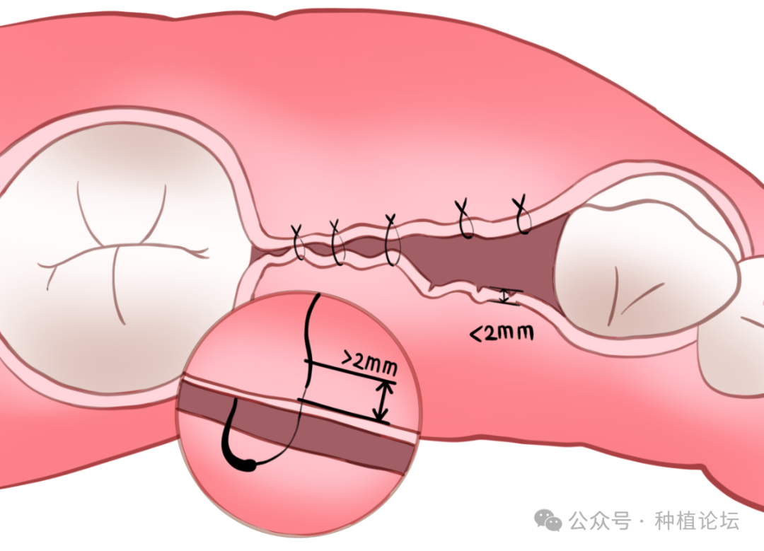 骨增量术后感染的处理及预防