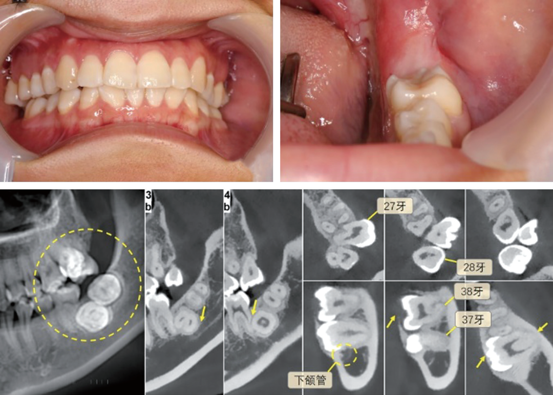 牙瘤19例CBCT影像学分析