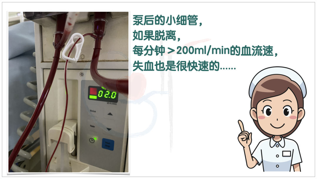 为什么要用泵上注射器小隐患大事故，透析时肝素泵管接口漏血，如何预防？_https://www.jmylbn.com_新闻资讯_第5张