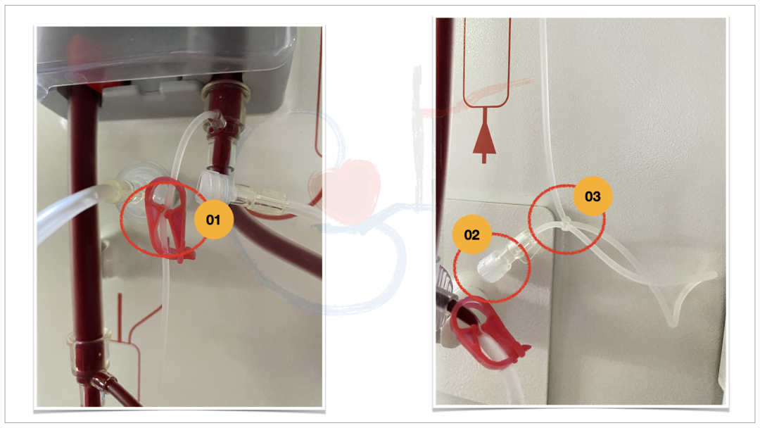 为什么要用泵上注射器小隐患大事故，透析时肝素泵管接口漏血，如何预防？_https://www.jmylbn.com_新闻资讯_第9张