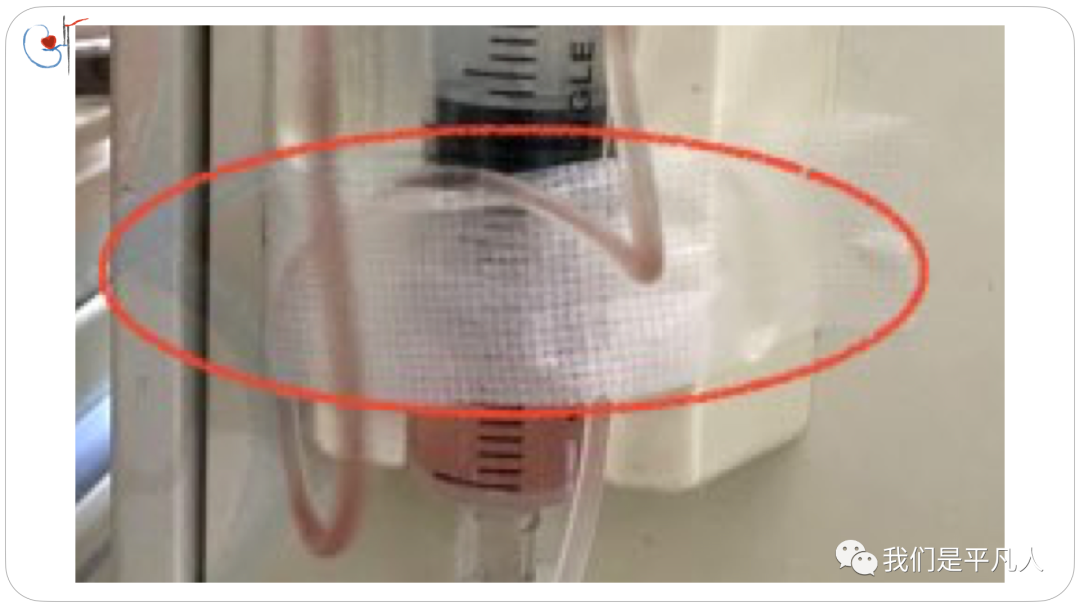 为什么要用泵上注射器小隐患大事故，透析时肝素泵管接口漏血，如何预防？_https://www.jmylbn.com_新闻资讯_第8张