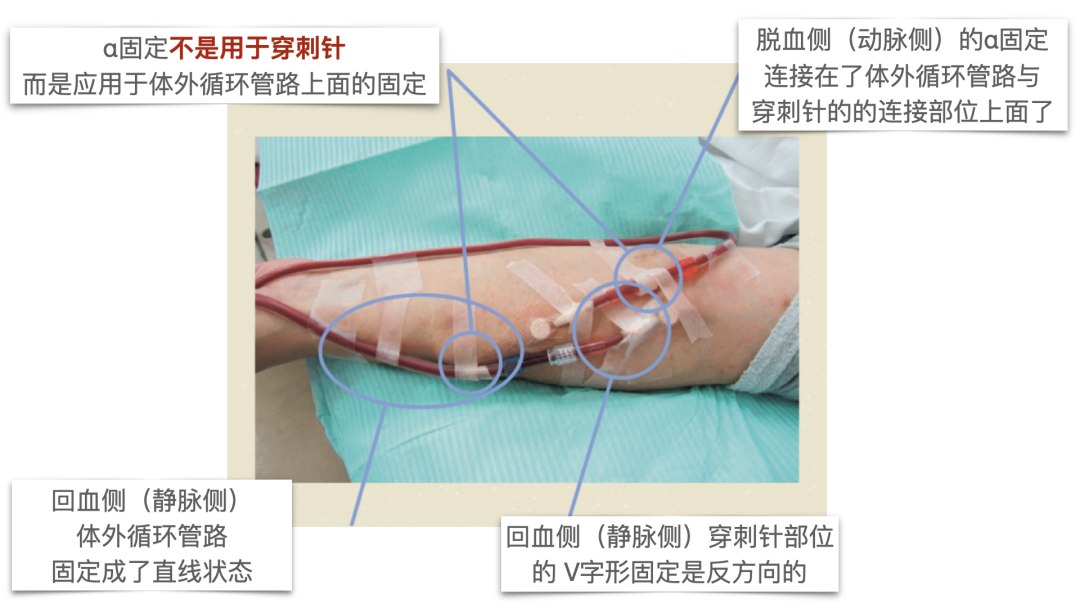 穿刺针怎么用V字固定、α固定、Ω固定，透析管路和穿刺针的固定方法，您用对了吗？_https://www.jmylbn.com_新闻资讯_第5张
