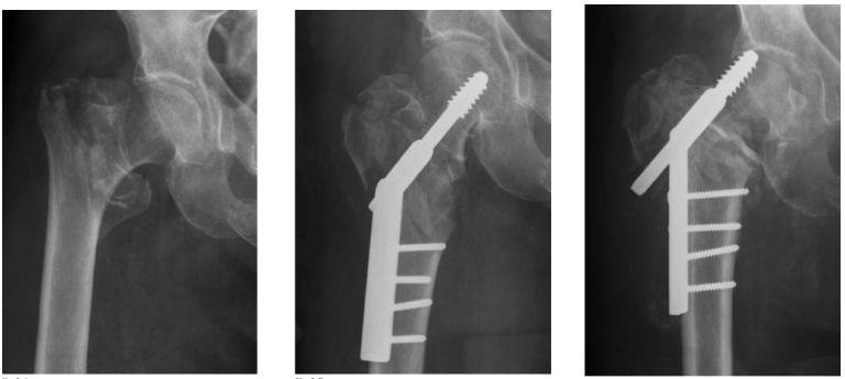 生物钉是什么材料骨折常用内固定材料&选择原则，超详细！_https://www.jmylbn.com_新闻资讯_第69张