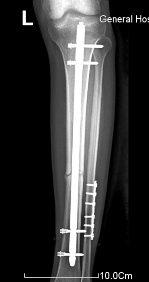 生物钉是什么材料骨折常用内固定材料&选择原则，超详细！_https://www.jmylbn.com_新闻资讯_第64张