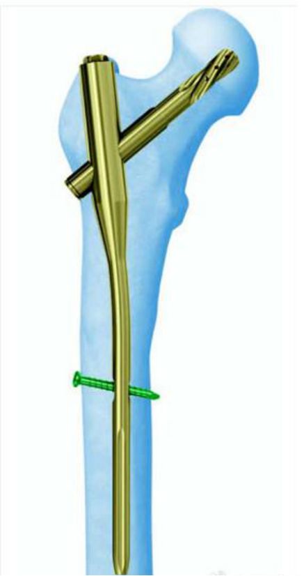 生物钉是什么材料骨折常用内固定材料&选择原则，超详细！_https://www.jmylbn.com_新闻资讯_第70张