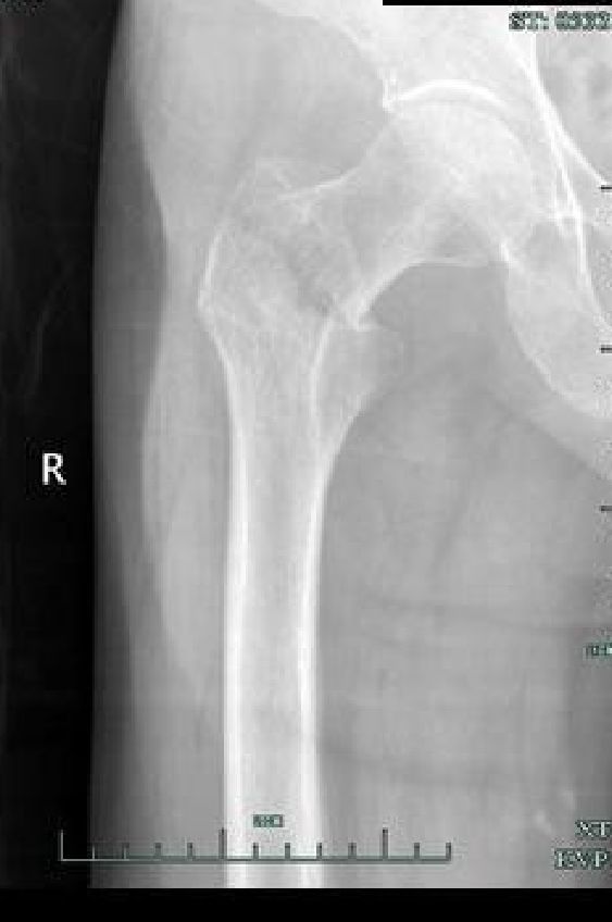 生物钉是什么材料骨折常用内固定材料&选择原则，超详细！_https://www.jmylbn.com_新闻资讯_第78张