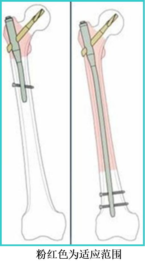 生物钉是什么材料骨折常用内固定材料&选择原则，超详细！_https://www.jmylbn.com_新闻资讯_第75张
