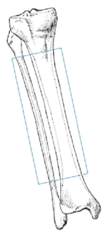 生物钉是什么材料骨折常用内固定材料&选择原则，超详细！_https://www.jmylbn.com_新闻资讯_第62张