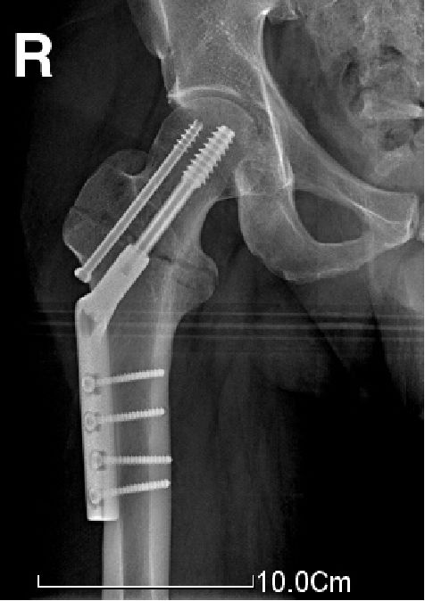 生物钉是什么材料骨折常用内固定材料&选择原则，超详细！_https://www.jmylbn.com_新闻资讯_第68张