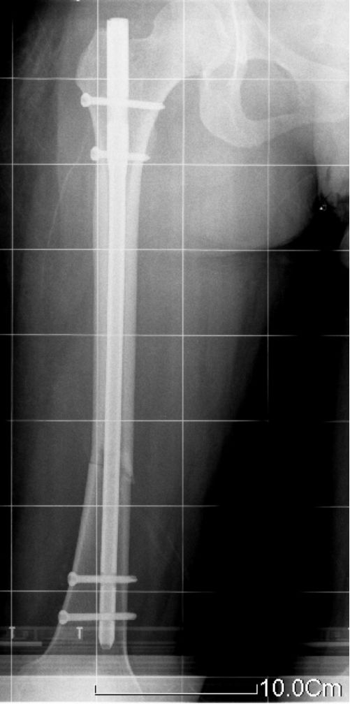 生物钉是什么材料骨折常用内固定材料&选择原则，超详细！_https://www.jmylbn.com_新闻资讯_第60张