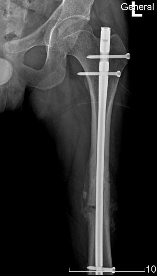 生物钉是什么材料骨折常用内固定材料&选择原则，超详细！_https://www.jmylbn.com_新闻资讯_第59张