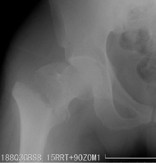 生物钉是什么材料骨折常用内固定材料&选择原则，超详细！_https://www.jmylbn.com_新闻资讯_第67张