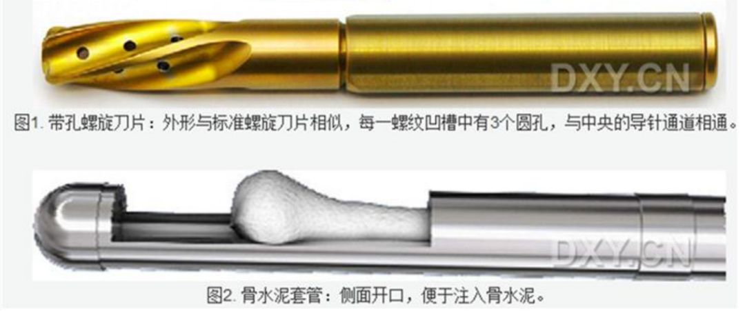 生物钉是什么材料骨折常用内固定材料&选择原则，超详细！_https://www.jmylbn.com_新闻资讯_第71张