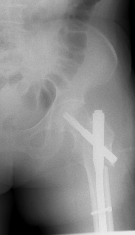 生物钉是什么材料骨折常用内固定材料&选择原则，超详细！_https://www.jmylbn.com_新闻资讯_第77张