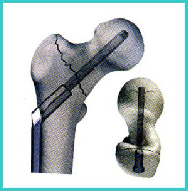 生物钉是什么材料骨折常用内固定材料&选择原则，超详细！_https://www.jmylbn.com_新闻资讯_第66张