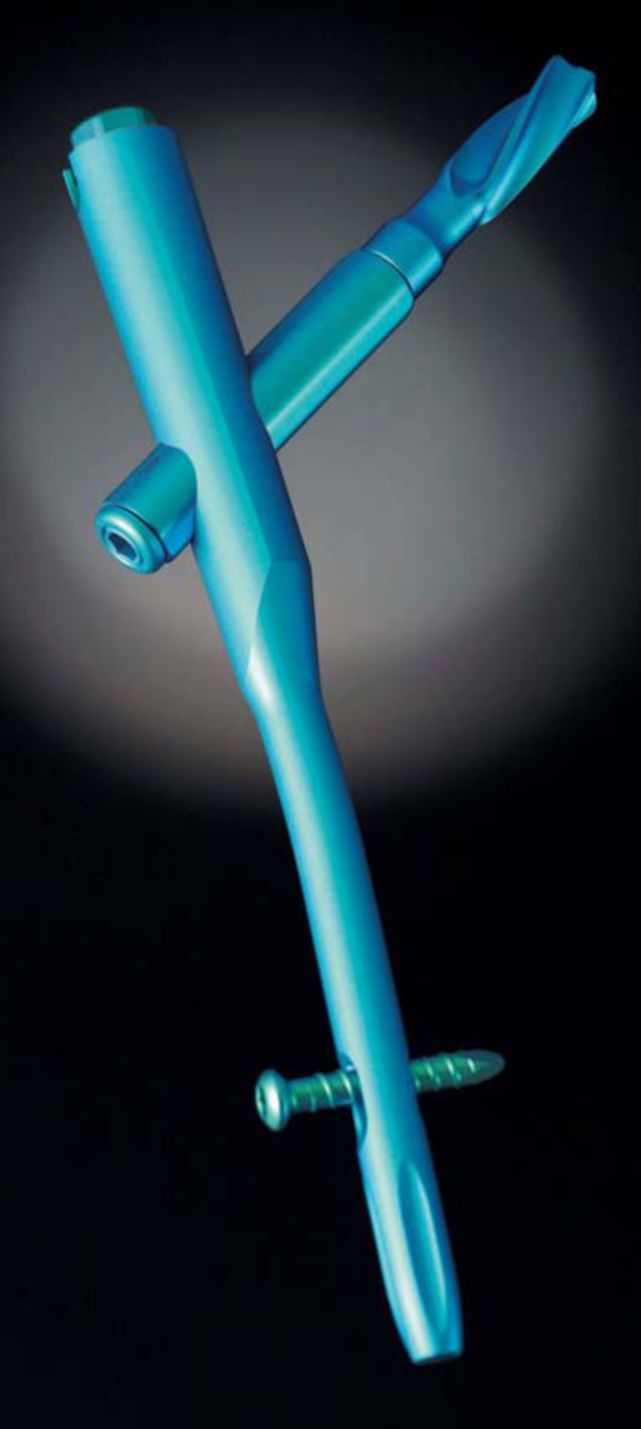 生物钉是什么材料骨折常用内固定材料&选择原则，超详细！_https://www.jmylbn.com_新闻资讯_第72张