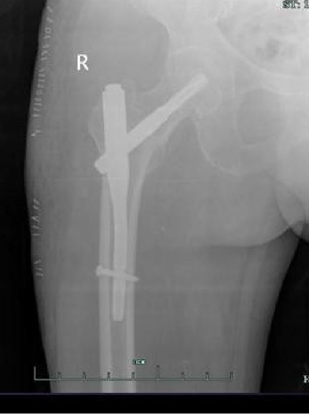 生物钉是什么材料骨折常用内固定材料&选择原则，超详细！_https://www.jmylbn.com_新闻资讯_第79张