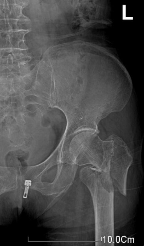 生物钉是什么材料骨折常用内固定材料&选择原则，超详细！_https://www.jmylbn.com_新闻资讯_第76张