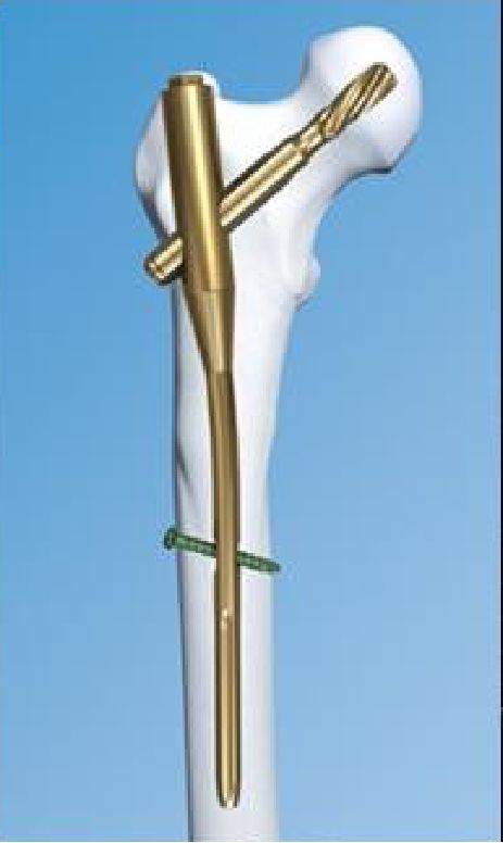 生物钉是什么材料骨折常用内固定材料&选择原则，超详细！_https://www.jmylbn.com_新闻资讯_第73张