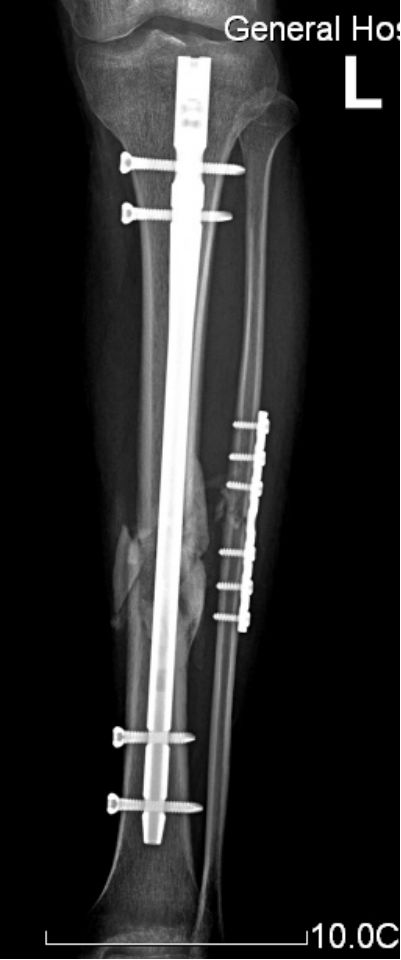 生物钉是什么材料骨折常用内固定材料&选择原则，超详细！_https://www.jmylbn.com_新闻资讯_第63张