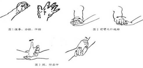 骨折病人该如何进行功能锻炼本文告诉你答案