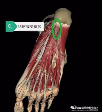 足跟腱鞘炎的位置图图片