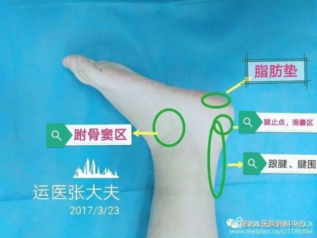 十种常见跟痛症的诊治方法-黄国义副主任医师-爱问医生