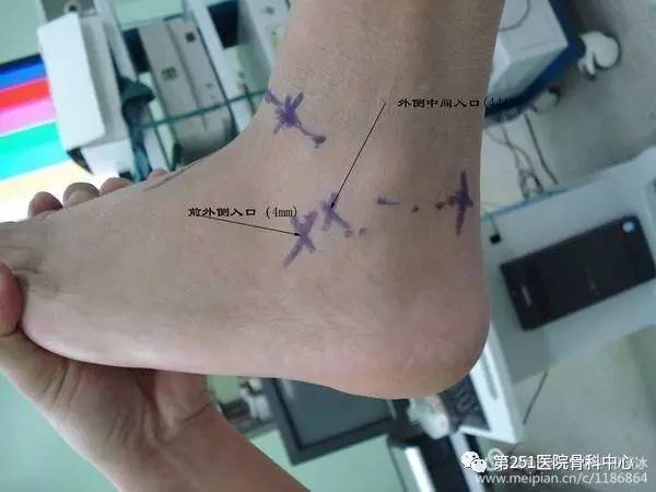 跗骨窦综合征指踝扭伤后跗骨窦的持续性疼痛,发病机制不清,可能与距跟