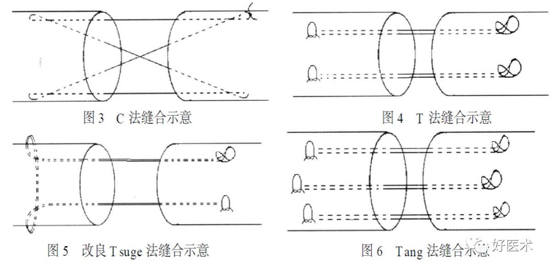 什么是无创缝合肌腱缝合术原则及方法汇总，分享给你~_https://www.jmylbn.com_新闻资讯_第18张
