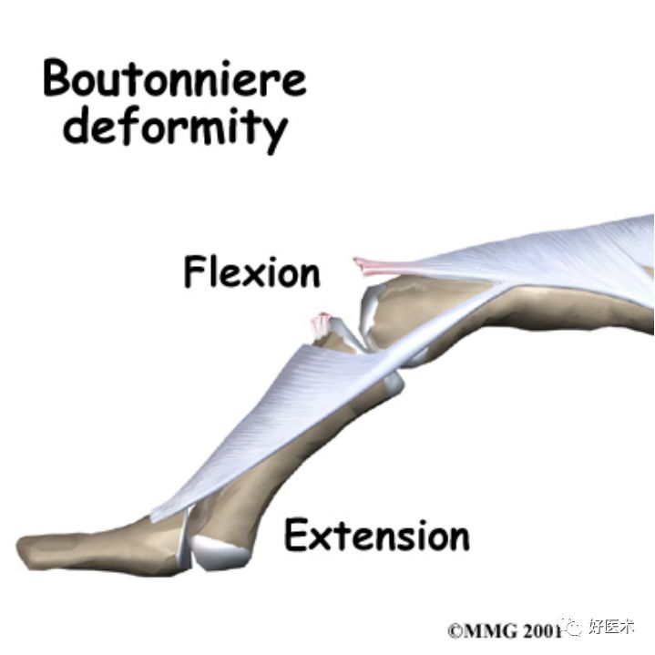 什么是无创缝合肌腱缝合术原则及方法汇总，分享给你~_https://www.jmylbn.com_新闻资讯_第4张