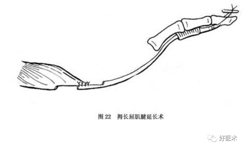 什么是无创缝合肌腱缝合术原则及方法汇总，分享给你~_https://www.jmylbn.com_新闻资讯_第26张