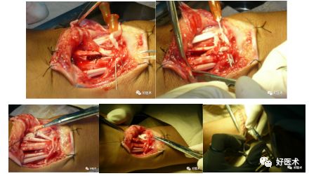 什么是无创缝合肌腱缝合术原则及方法汇总，分享给你~_https://www.jmylbn.com_新闻资讯_第27张