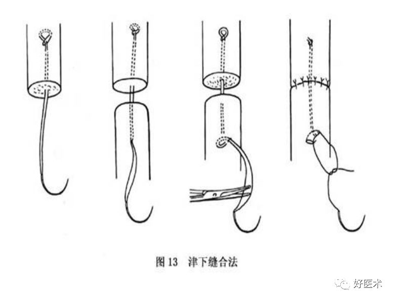 什么是无创缝合肌腱缝合术原则及方法汇总，分享给你~_https://www.jmylbn.com_新闻资讯_第16张