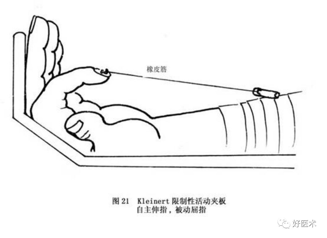 什么是无创缝合肌腱缝合术原则及方法汇总，分享给你~_https://www.jmylbn.com_新闻资讯_第25张