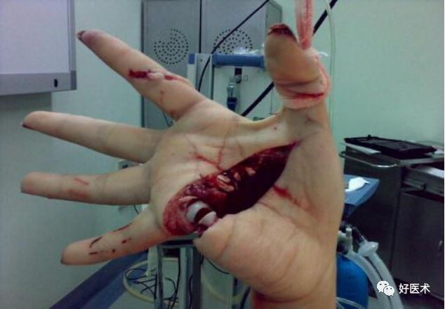 什么是无创缝合肌腱缝合术原则及方法汇总，分享给你~_https://www.jmylbn.com_新闻资讯_第5张