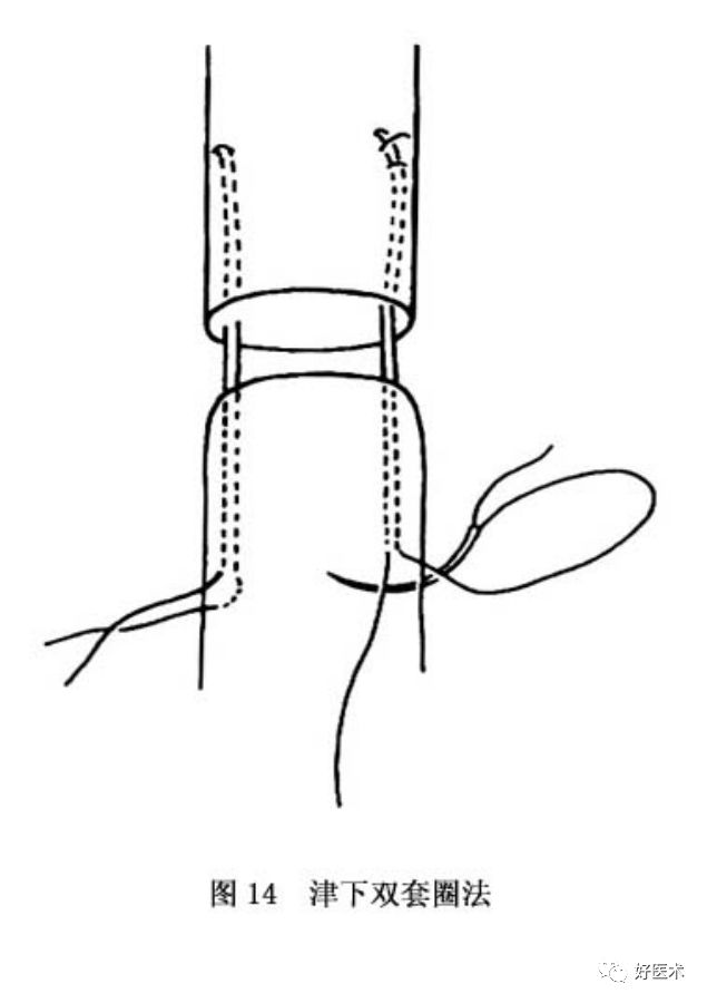 什么是无创缝合肌腱缝合术原则及方法汇总，分享给你~_https://www.jmylbn.com_新闻资讯_第17张