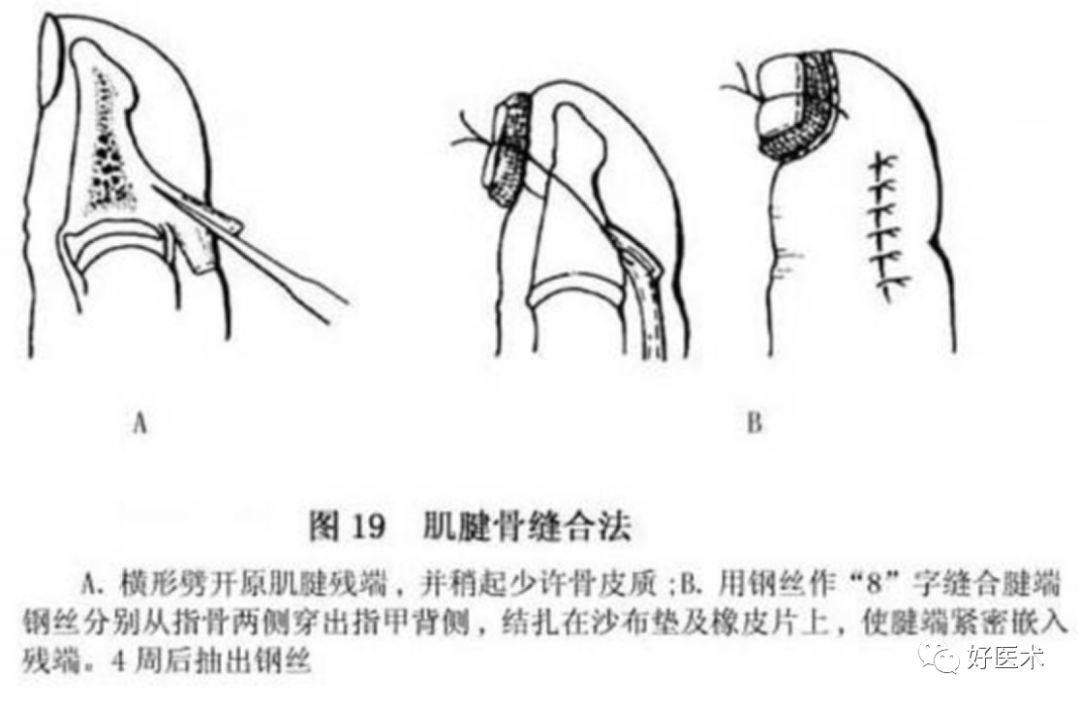 什么是无创缝合肌腱缝合术原则及方法汇总，分享给你~_https://www.jmylbn.com_新闻资讯_第23张