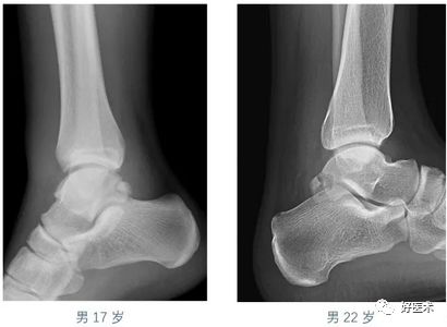 常见的几种骨骼发育异常,容易误诊为骨折,这要特注意!
