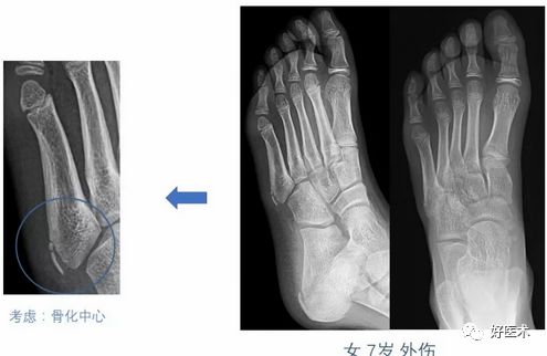 常见的几种骨骼发育异常,容易误诊为骨折,这要特注意!