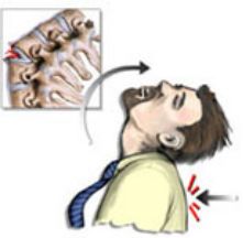 脊柱骨折的分型、诊断与治疗