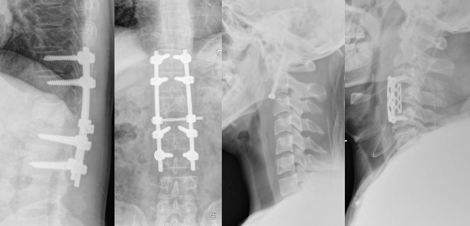 脊柱骨折的分型、诊断与治疗