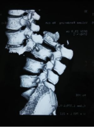 脊柱骨折的分型、诊断与治疗