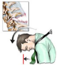 脊柱骨折的分型、诊断与治疗
